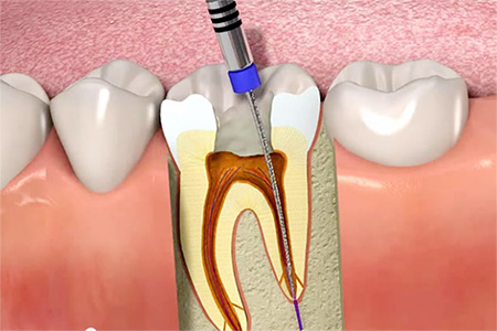 Endodontia (Tratamento de Canal)